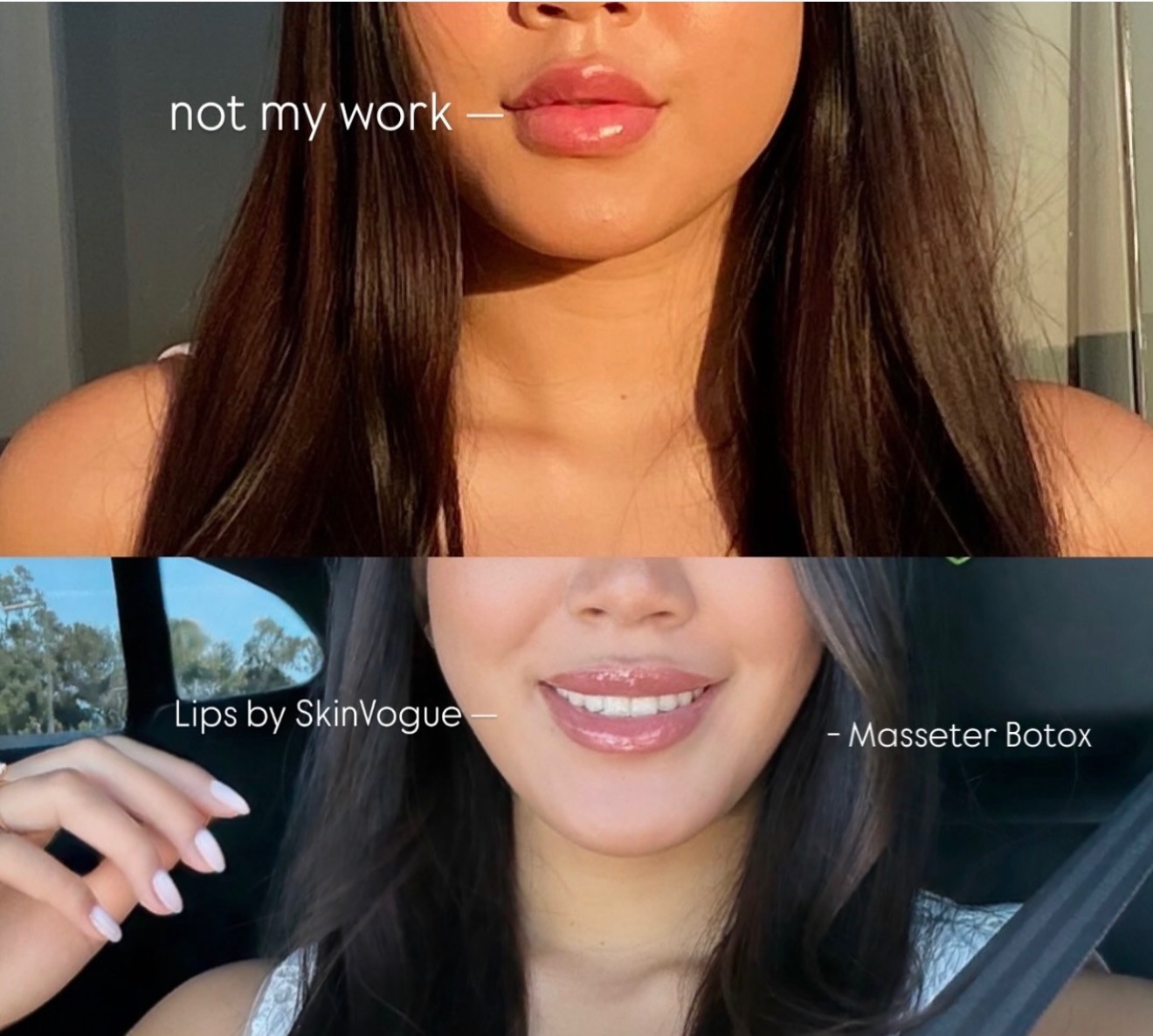 Lips by Skin Vogue MD