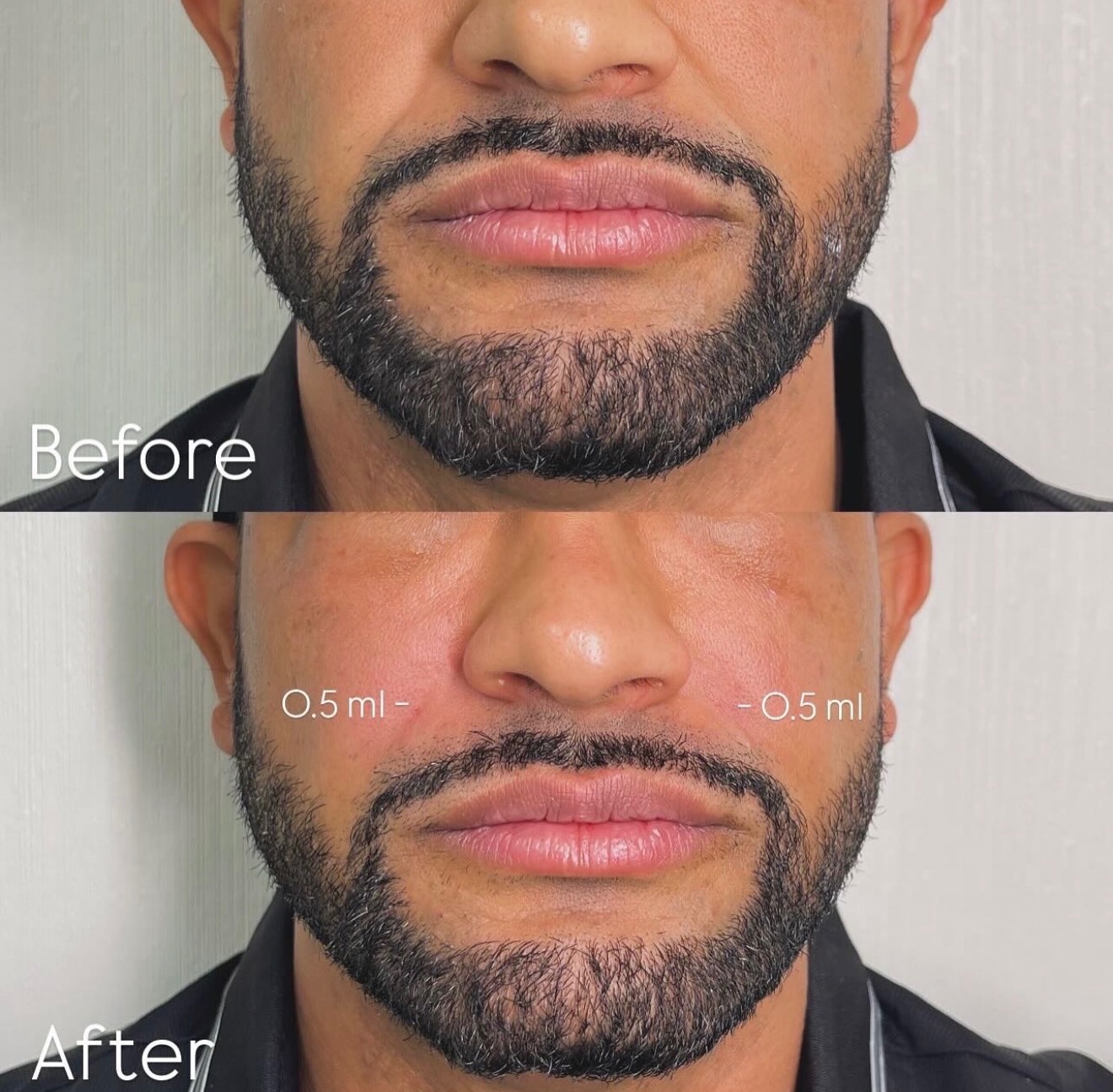 Nasolabial Fold Filler Results