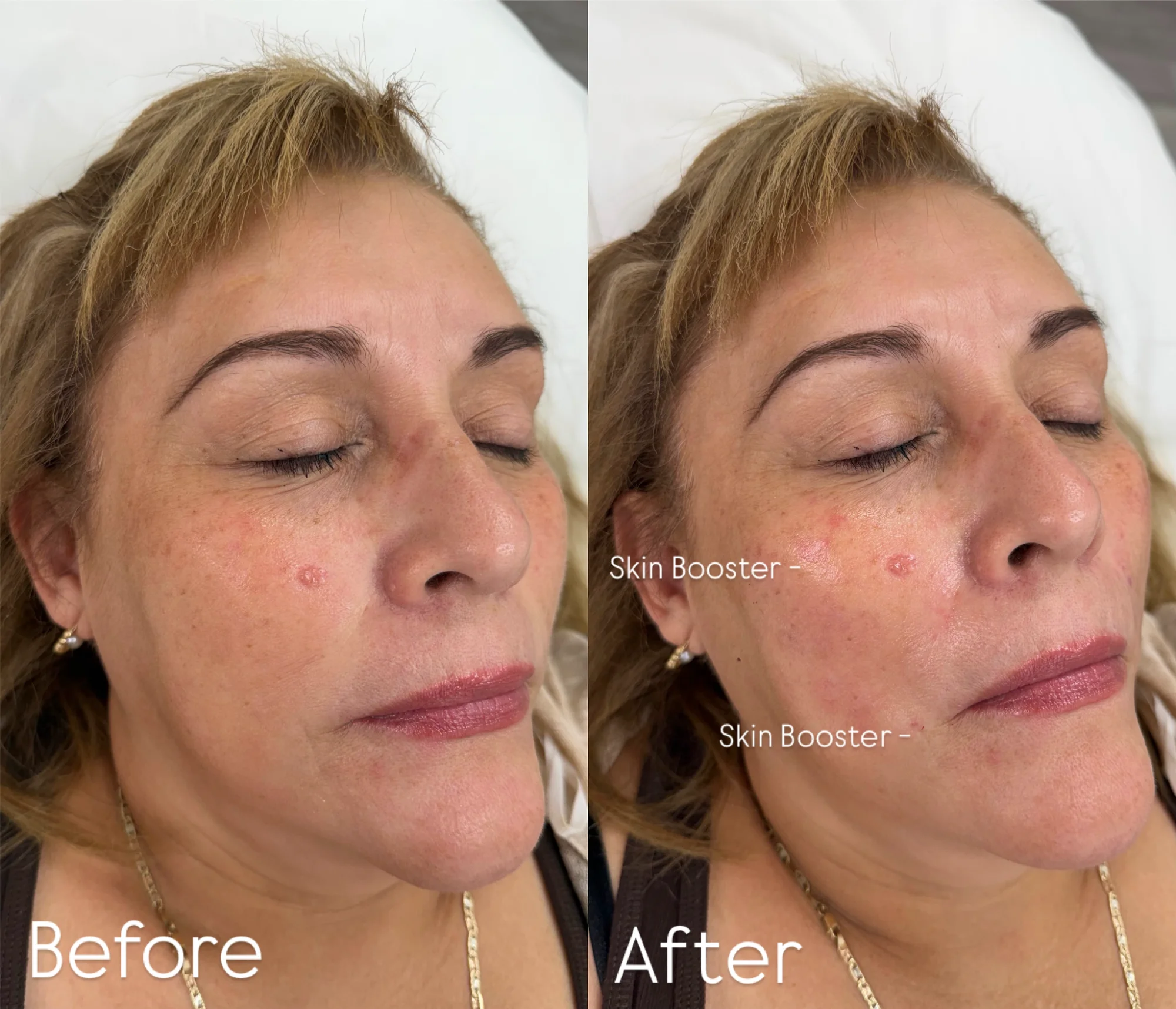 Skin Booster Results